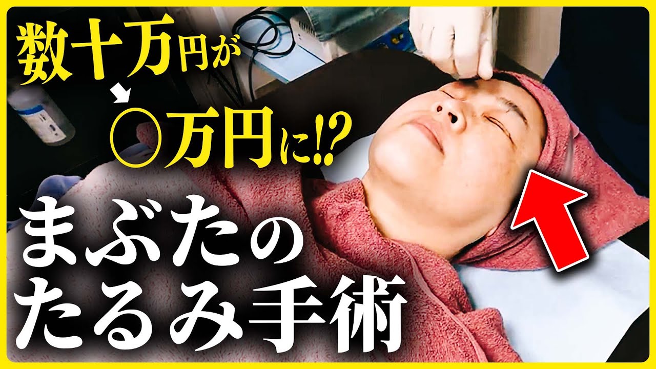 【40代50代必見】まぶたのたるみを手術！【眼瞼下垂】