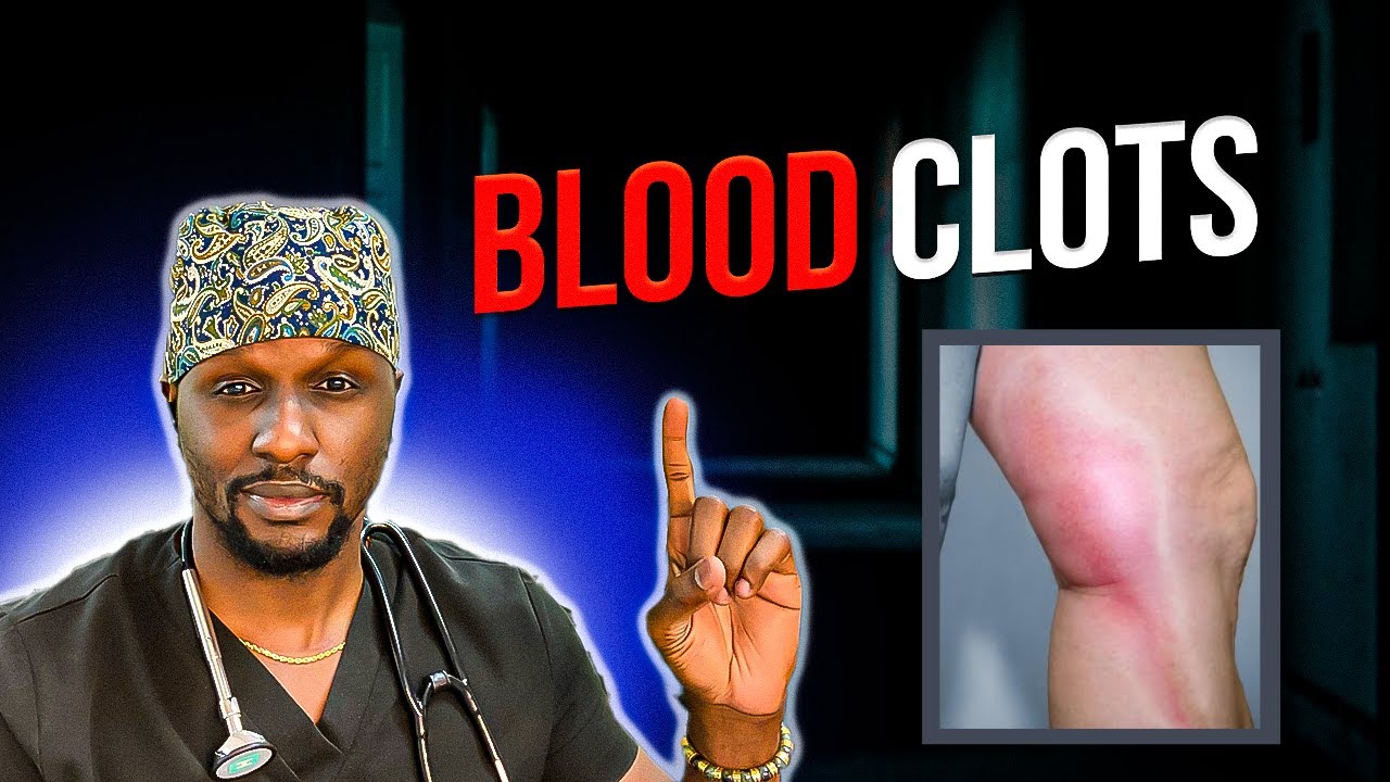 Blood Clot Dangers: Learn the Warning Signs