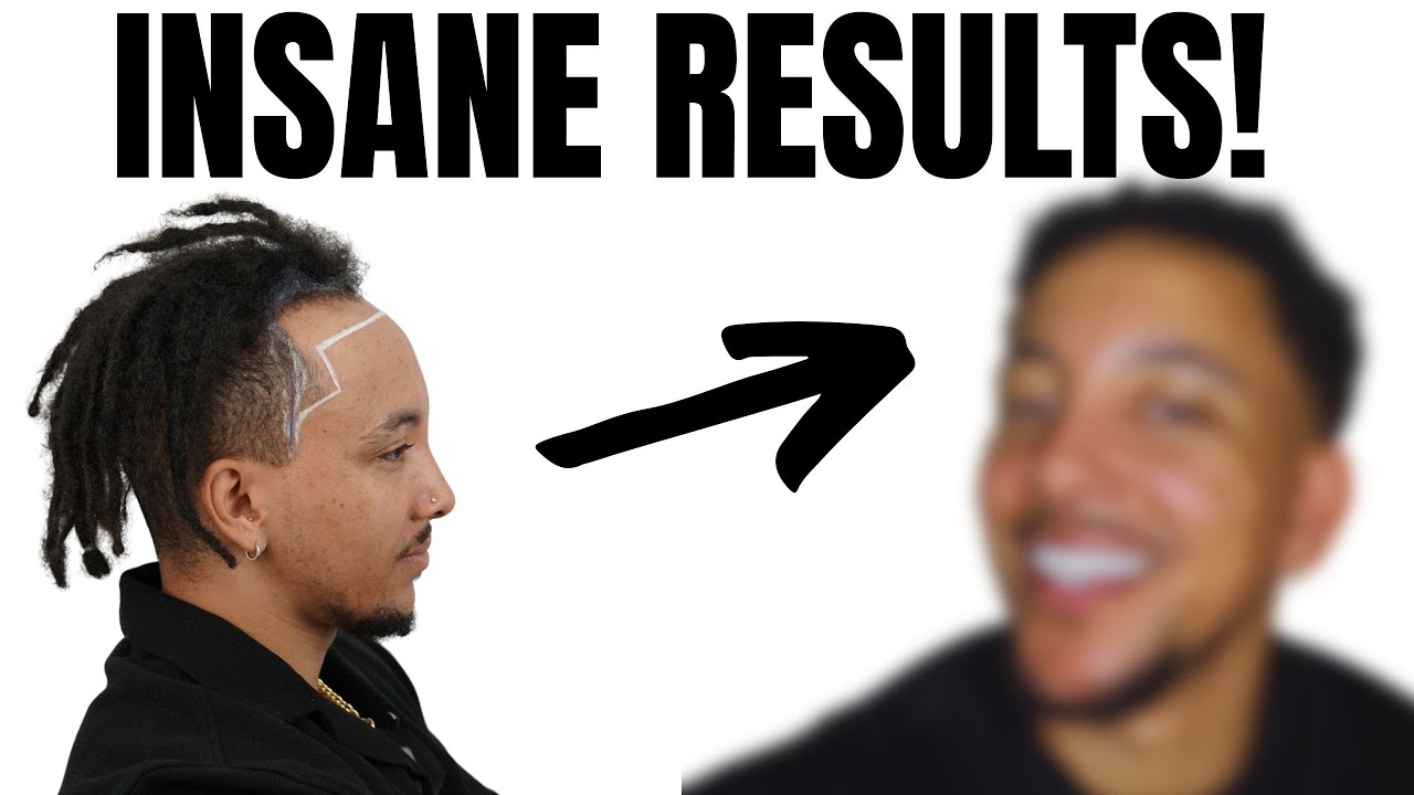 1 Year After My Hair Transplant – Before & After Results (Full Breakdown!) 🔥