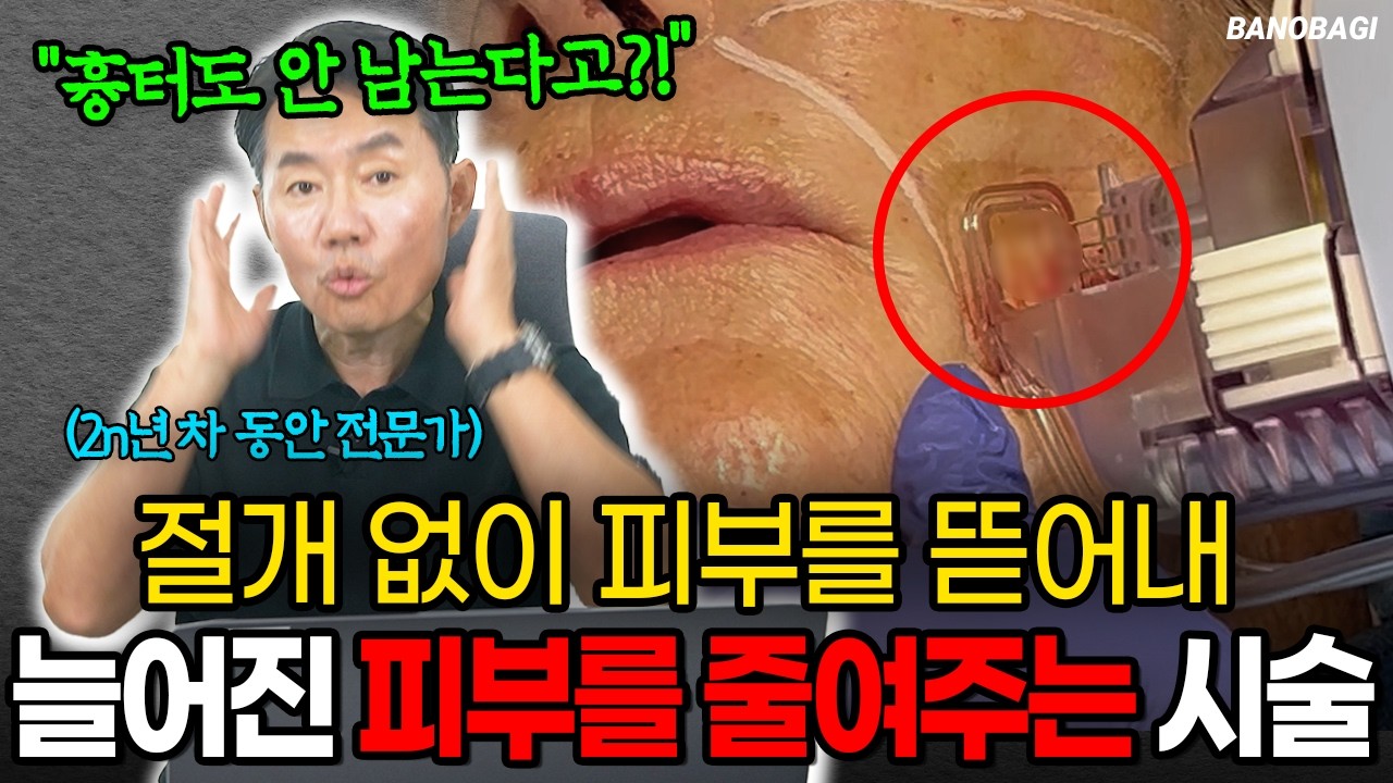 안면거상으로도 안 잡히던 입 주변 주름😰  열에너지 없이, 흉터 없이 해결 가능💖 비절개 리프팅 동안시술 엘라코어🔥