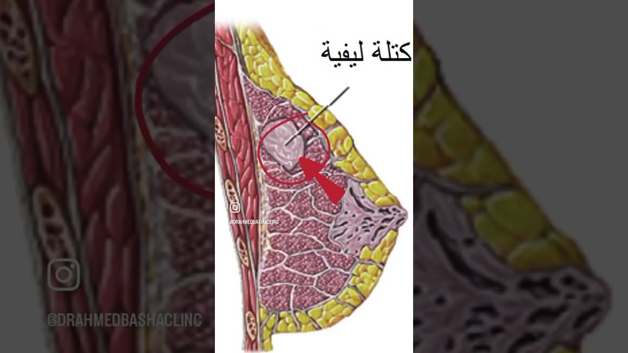 إمتى تقلقي لو في حاجة غير طبيعية في الثدي ؟؟؟؟ #دكتور_أحمد_باشا