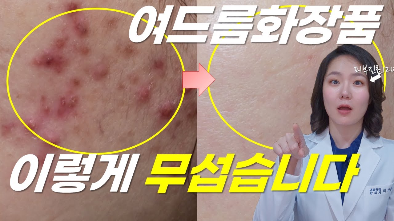 이걸 몰라서 여드름 계속 생깁니다 | 알려주기 아까운 좁쌀 화농성 여드름 화장품 사용법 3가지