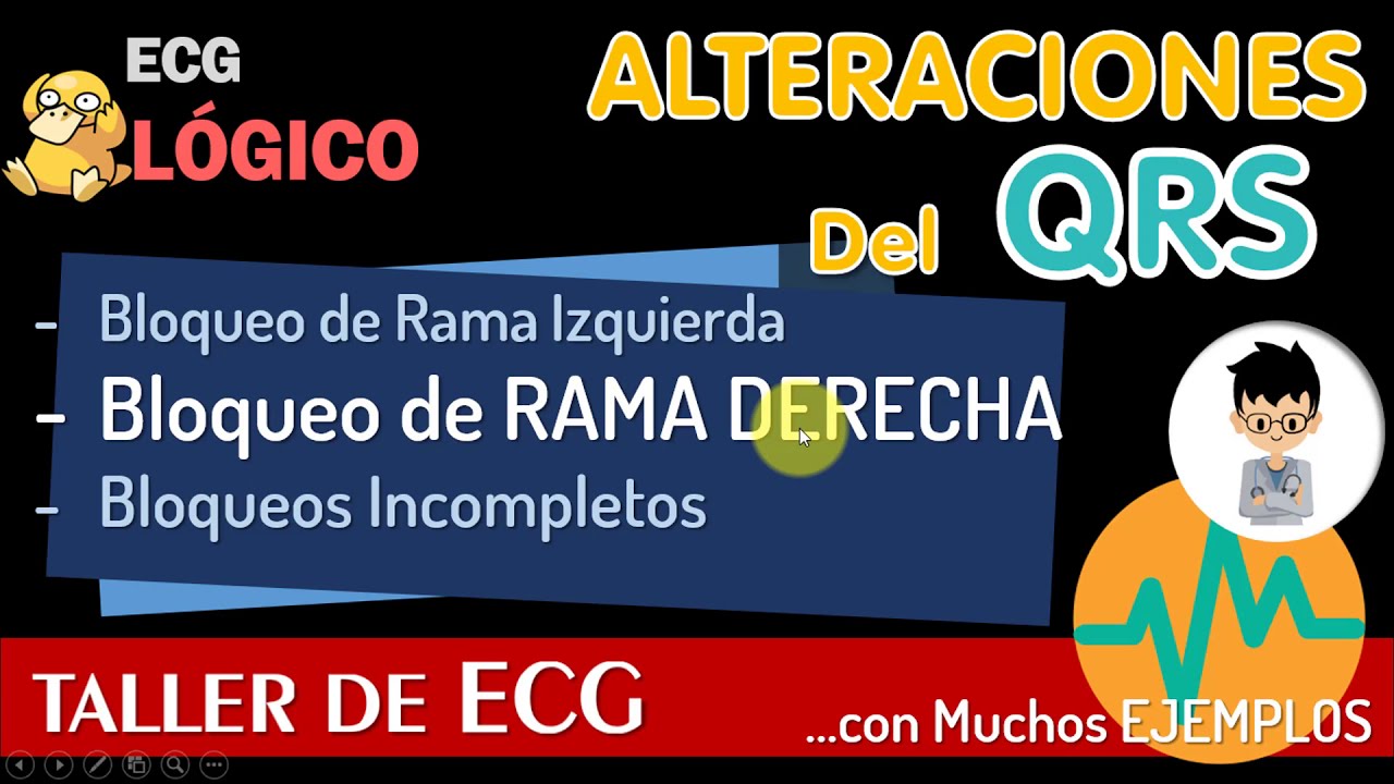 BLOQUEO completo e incompleto DE RAMA DERECHA, BCRD, CASO CLINICO, EJERCICIOS