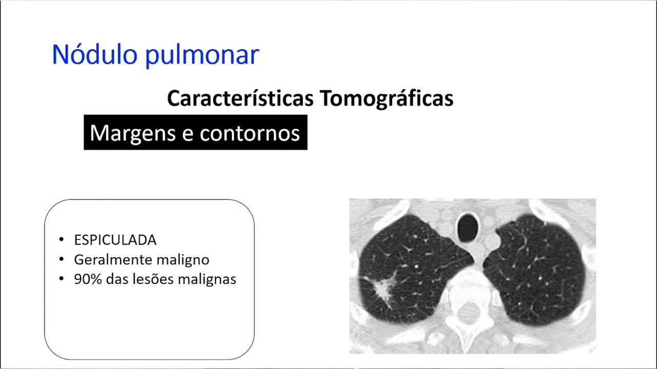 NÓDULO PULMONAR SOLITÁRIO