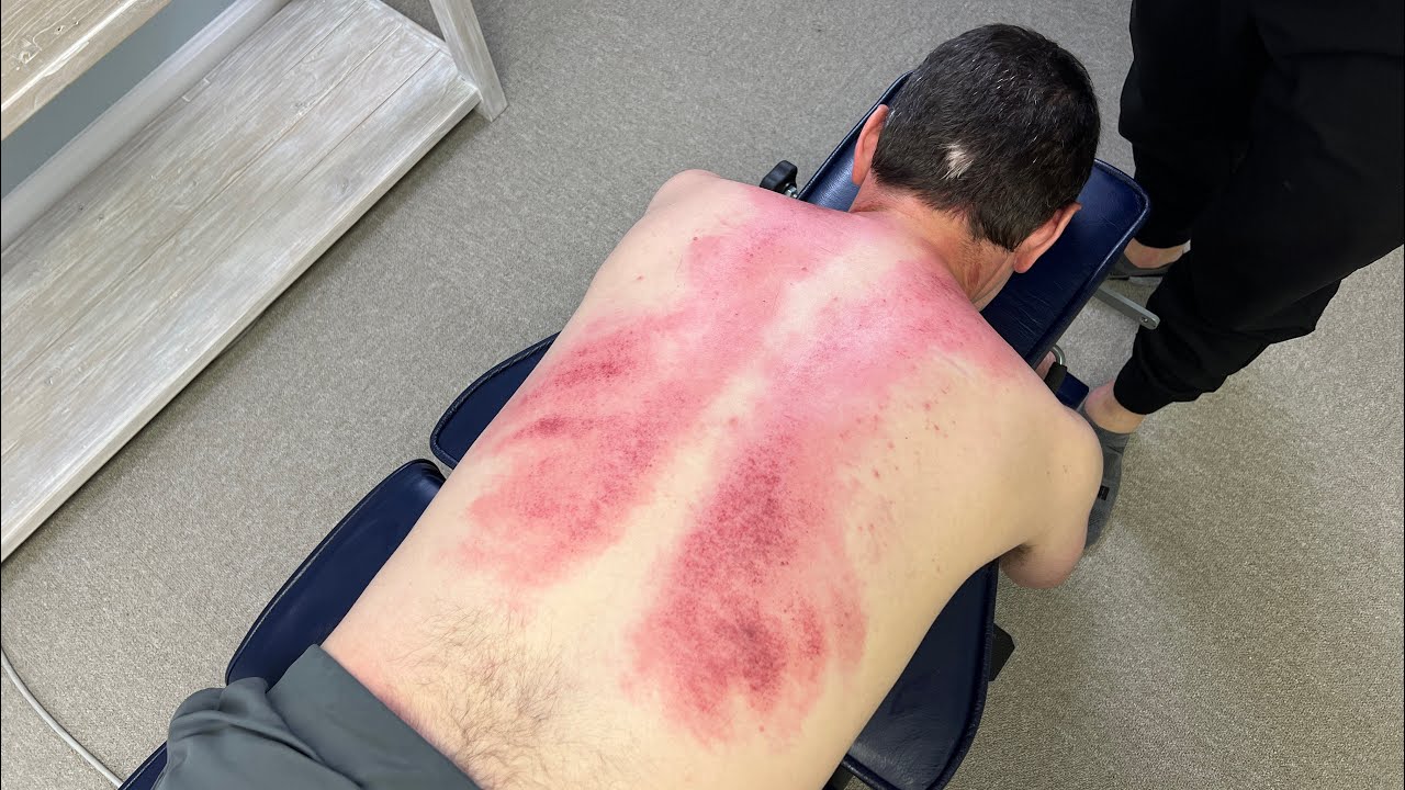 Extreme Gua Sha Flushes GUNK From Man's Back 😳 *Cracks* Purple Marks & Toxins Released!