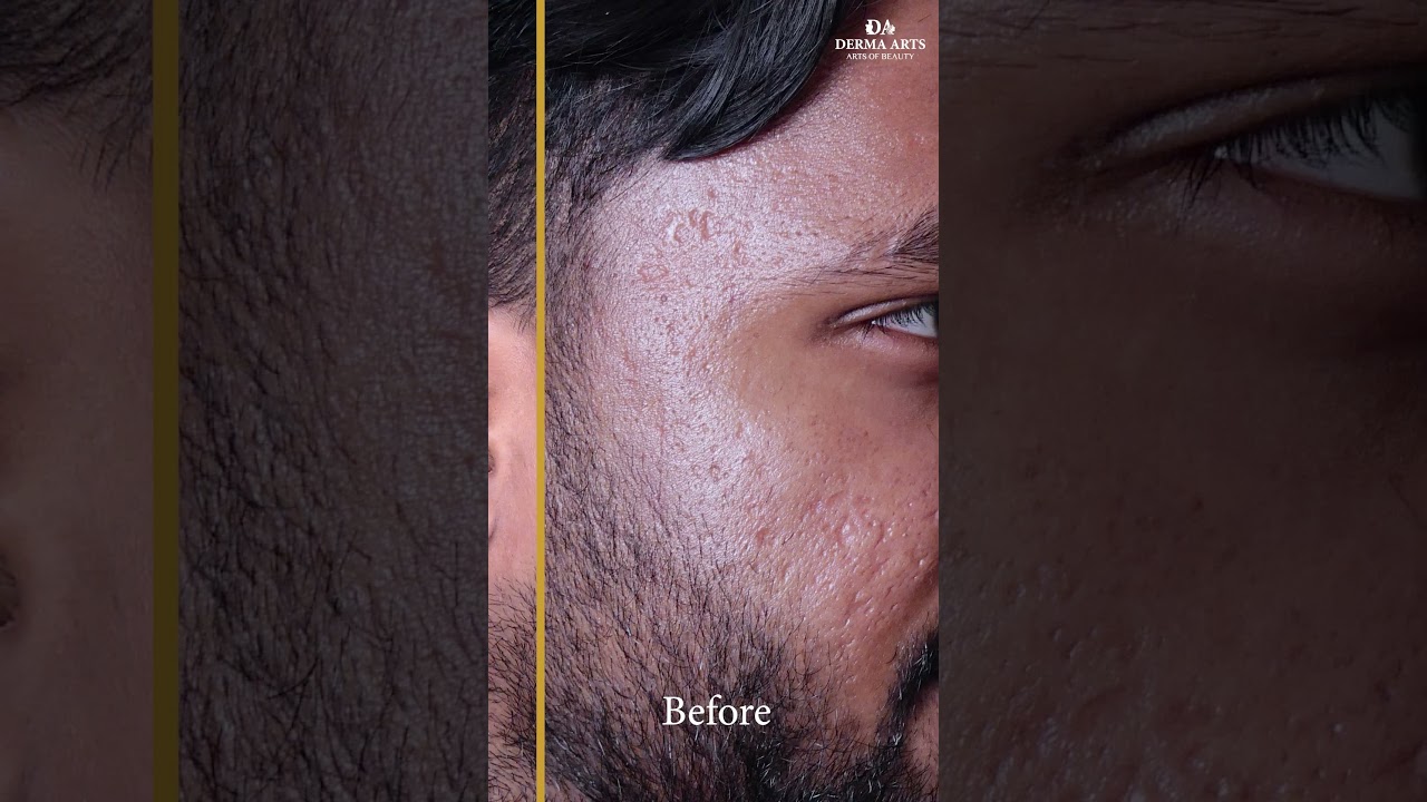 Hydra Facial Treatment Before and After | Dr. Mitra Amiri #dermaarts #drmitraamiri