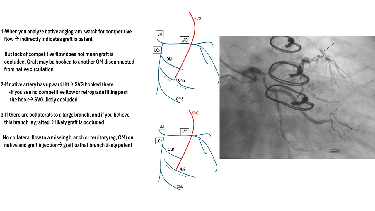 Grafts angiography tips