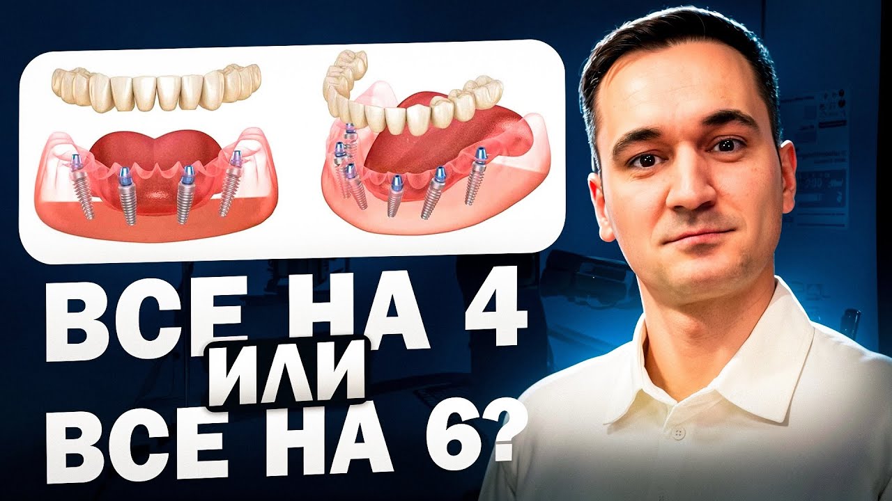 ВСЕ НА 4 ИЛИ ВСЕ НА 6? ЛУЧШИЙ СПОСОБ ИМПЛАНТАЦИИ ЗУБОВ, ЧТО ВЫБРАТЬ ALL IN 4 ИЛИ AII IN 6?