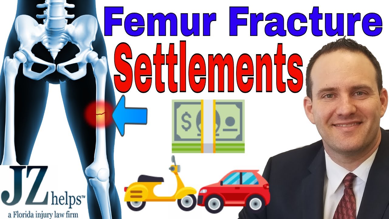 Femur (Upper Leg) Fracture Settlements from Car Accidents and More