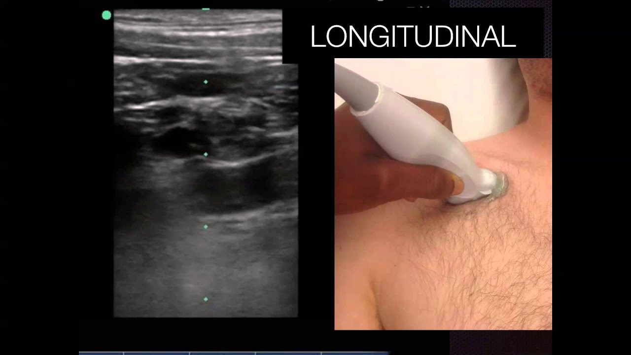 Tutorial Ultrasound Guided Subclavian Line