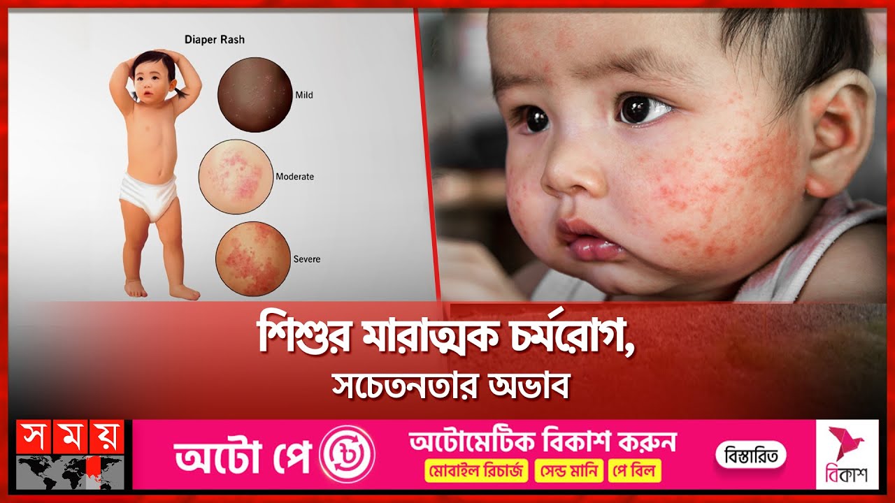 ‌‌‌‌শিশুর মারাত্মক চর্মরোগ, সচেতনতার অভাব | Severe Skin Disease in Children | Somoy TV