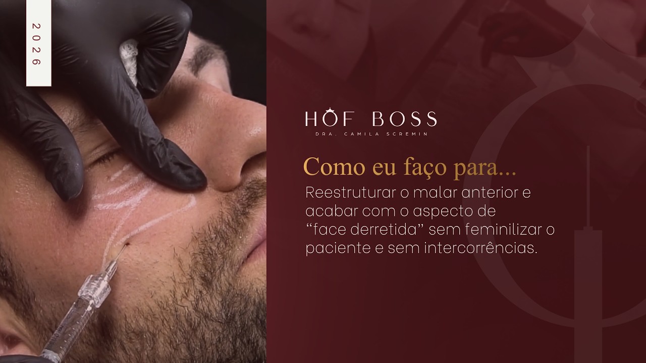 EP#1 - Como reestruturar o malar anterior para o aspecto de “face derretida” sem intercorrências