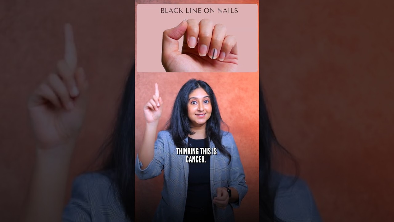 Black Lines on Nails | Cancer Warning or Harmless Pigmentation? #shorts #cancer #pigmentation
