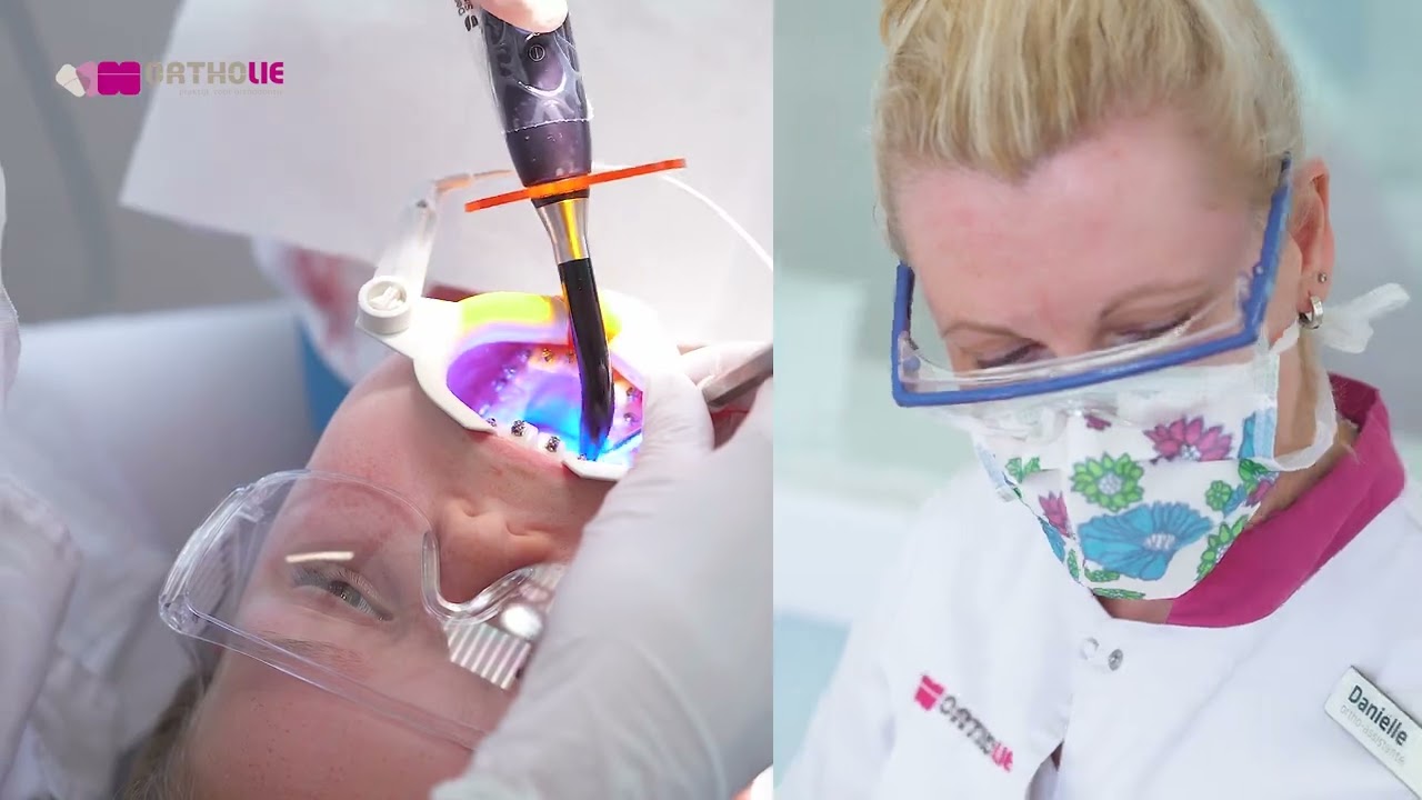 Ortholie | Praktijk voor Orthodontie | Plaatsen metalen brackets (slotjes beugel)