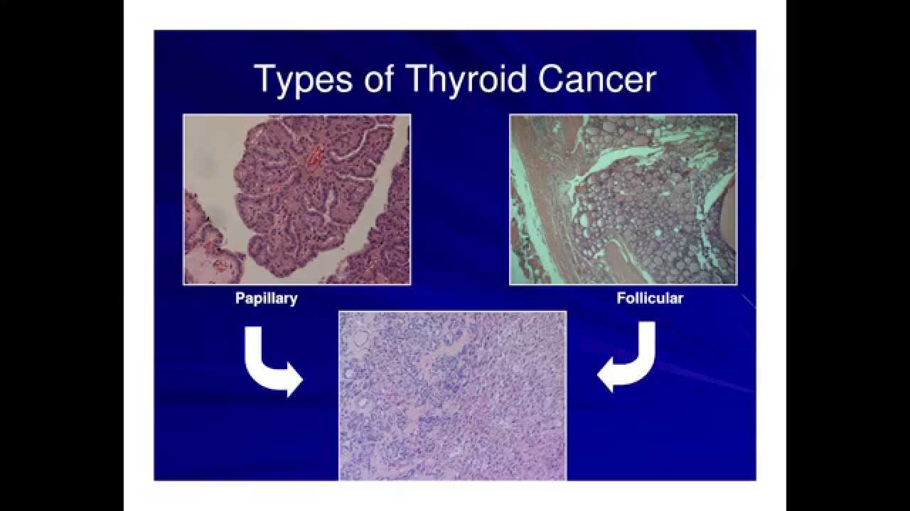 Molecular Testing of Thyroid Nodules -- Andrew Gianoukakis, MD
