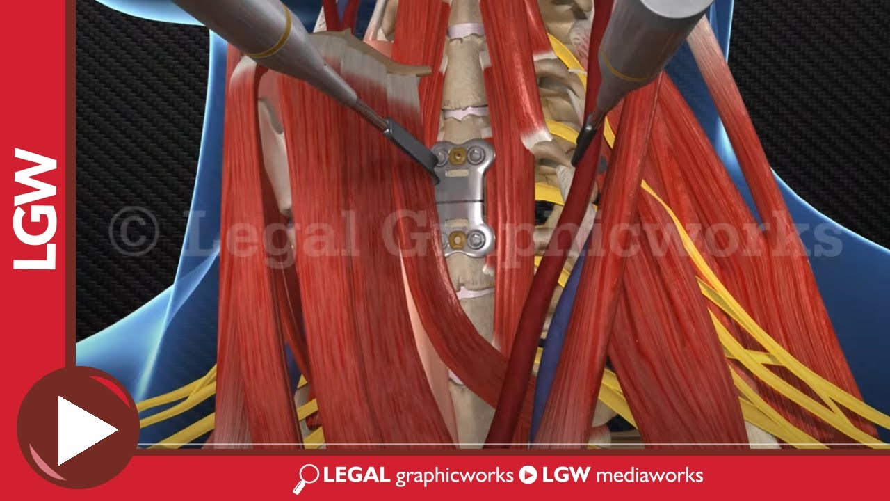 Cervical Fusion Surgery 3D animation C3-4 C5-6 C6-7