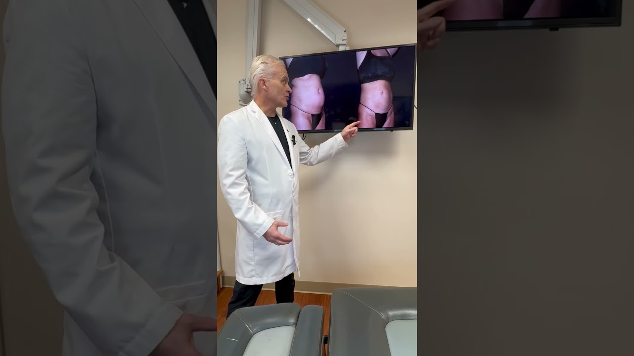 360&deg; Liposuction: See Real Lipo 360 Before & After