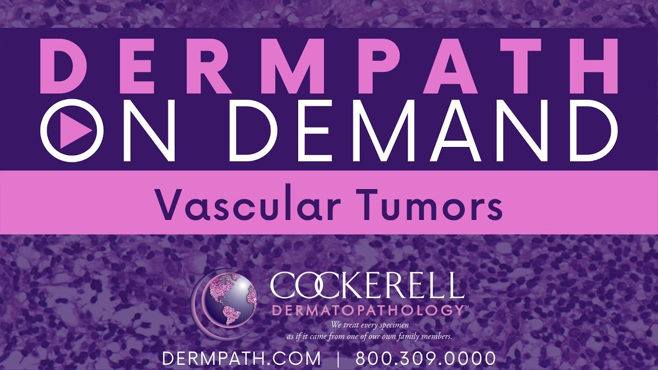 Vascular Tumors