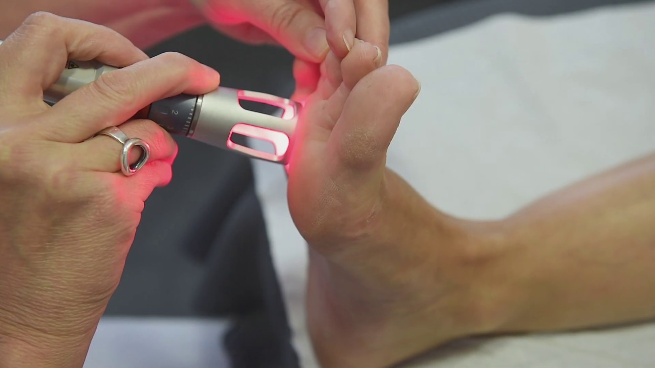 K-LASER : Syndrome de Morton, traitement et protocole