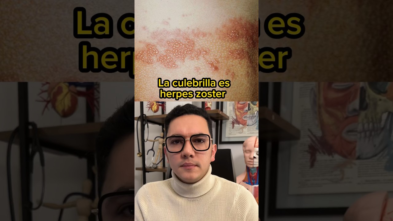 La culebrilla es herpes Zoster | Dr. William Guerrero #medicina #shorts