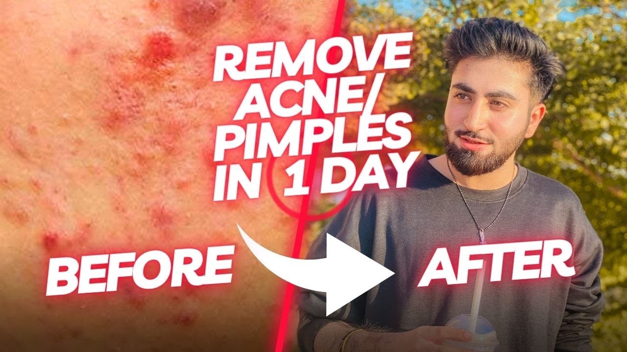 How to clear Acne Fast | How to clear Pimples in a day (Proven ways)