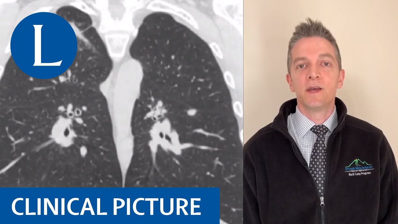 Insights into a new era of coal workers’ pneumoconiosis