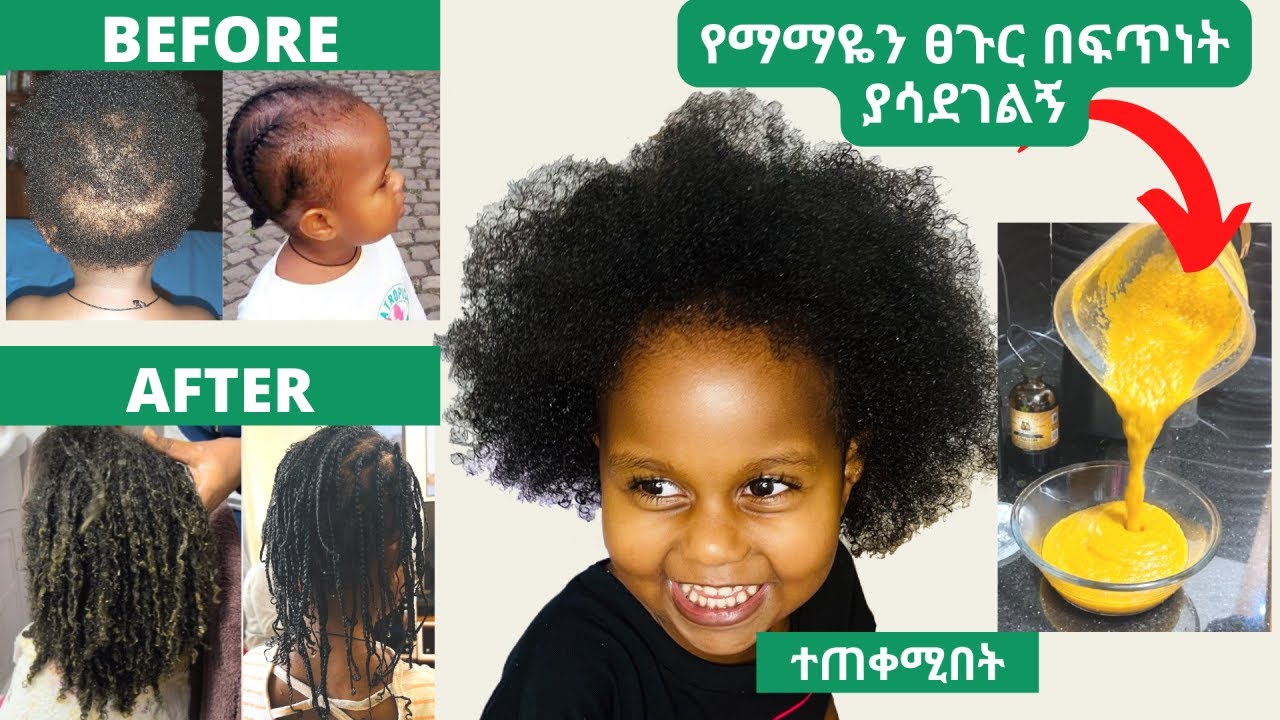 የልጅሽ ፀጉር አላድግ ካለሽ ይሄን ውህድ በሳምንት አንዴ ተጠቀሚው