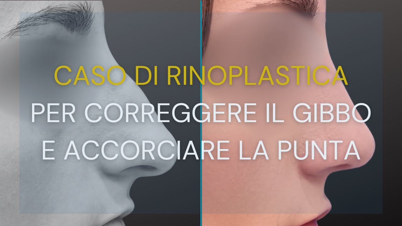 RINOPLASTICA per correggere gibbo e accorciare punta