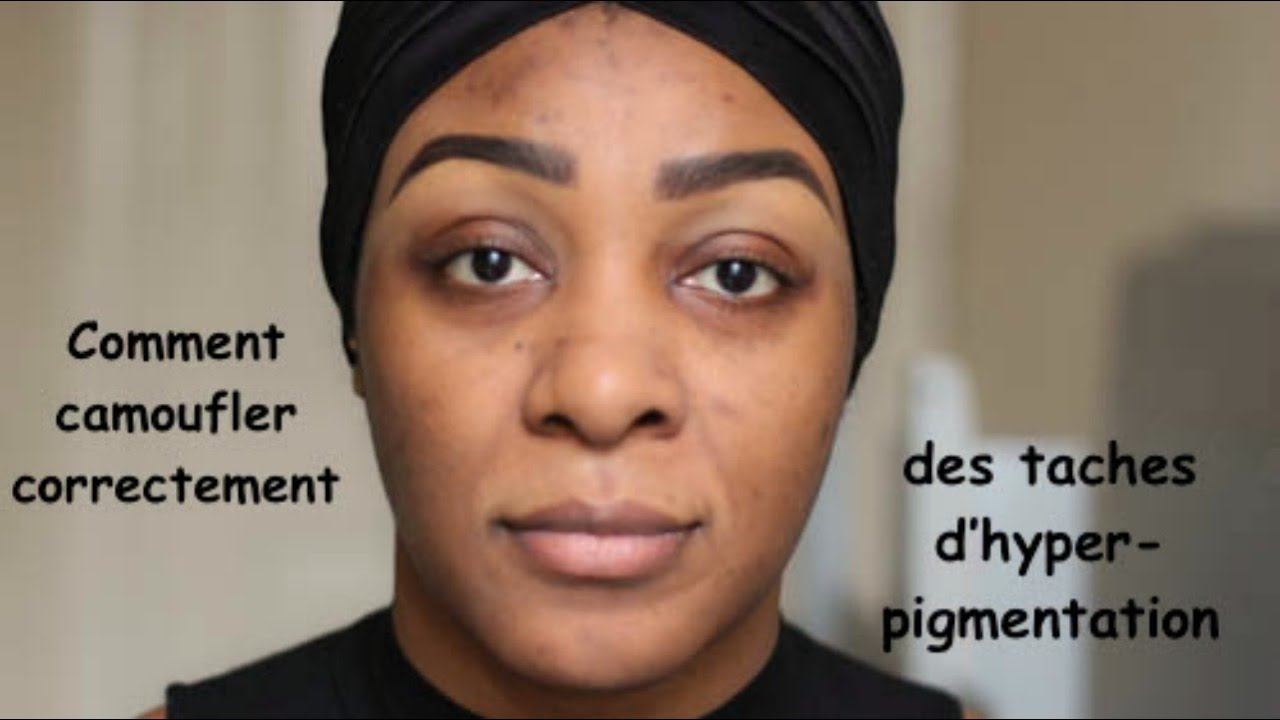 Comment: Camoufler des taches d'hyper-pigmentation (Peau Noir)