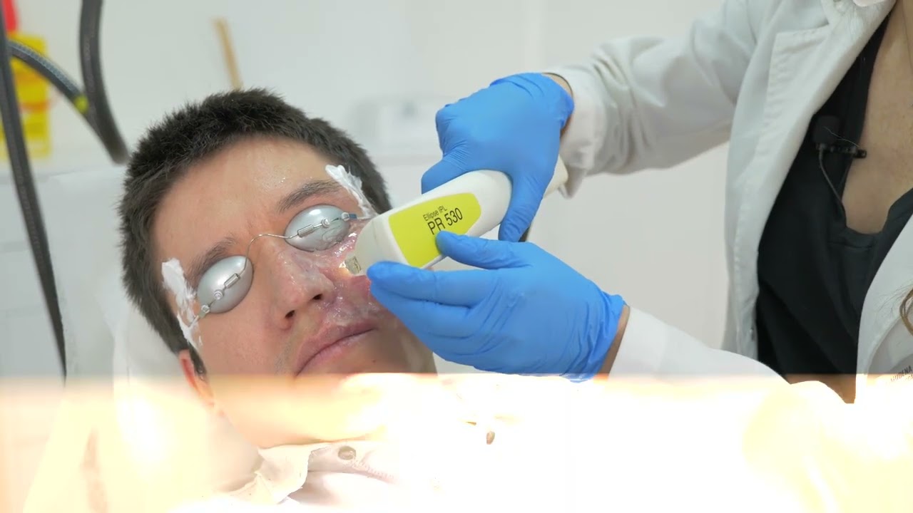 Tratamiento combinado de IPL y láser fraccionado para manchas de vino de Oporto y cicatrices de acné