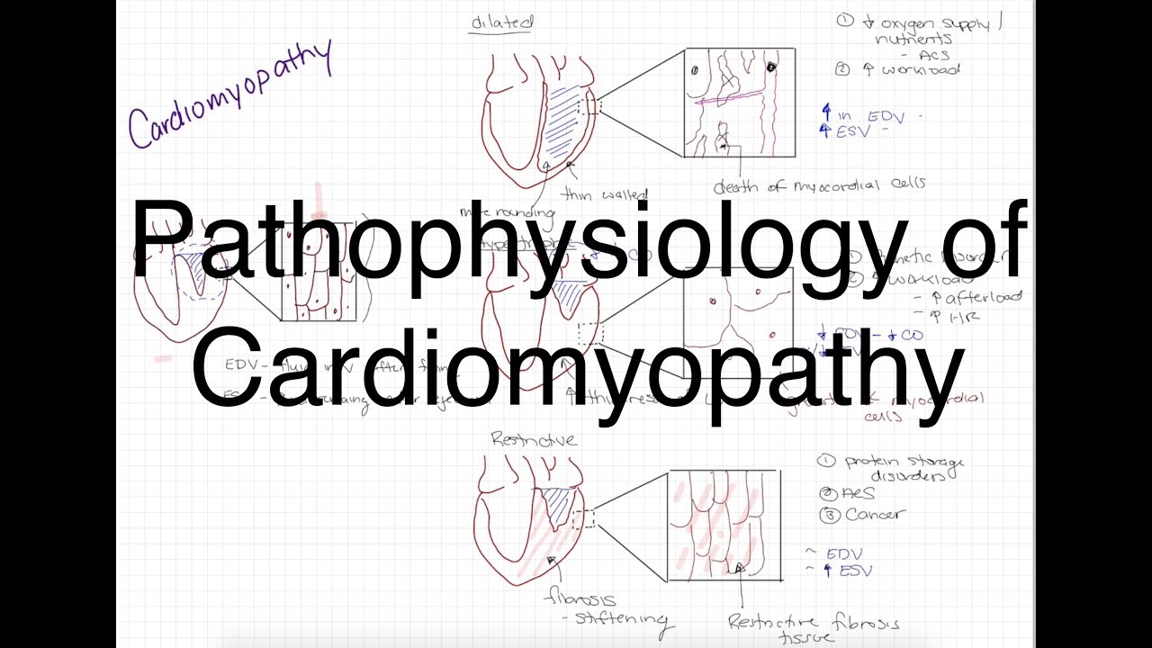 Pathophysiology of Cardiomyopathy