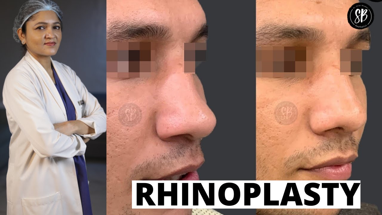 Rhinoplasty - Surgery for Wide/Deviated Nose | Nose Job in Gurugram, India