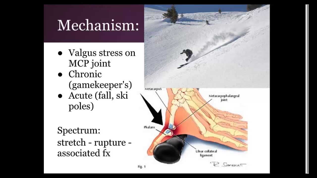 Gamekeeper's thumb:  "EM in 5"