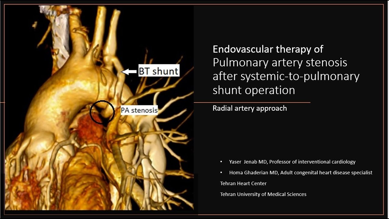 Endovasular approach for pulmonary stenosis after modified BT shunt operation in an adult patient