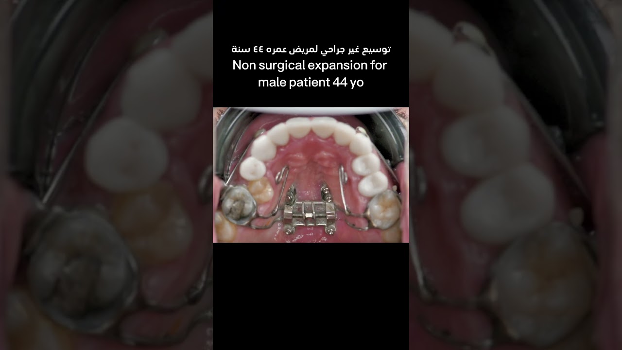 #marpe #clearaligners #aligners