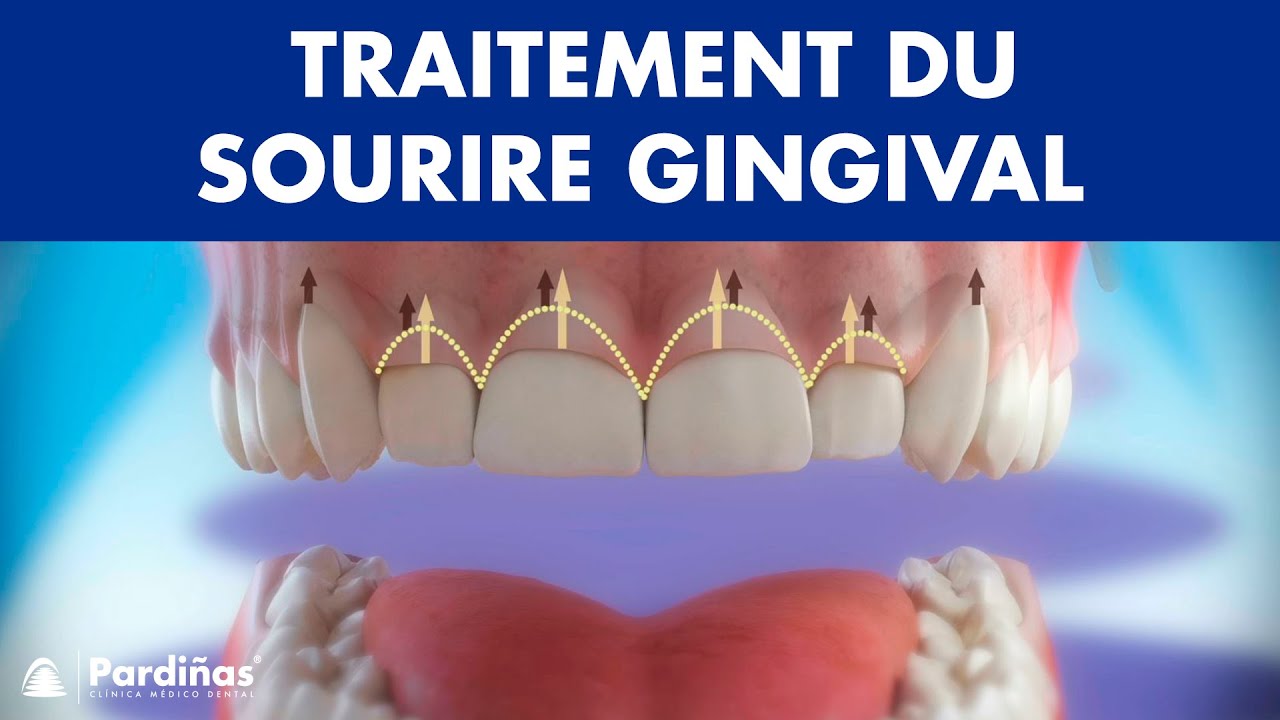 Gingivectomie  - Traitement du sourire gingival ©