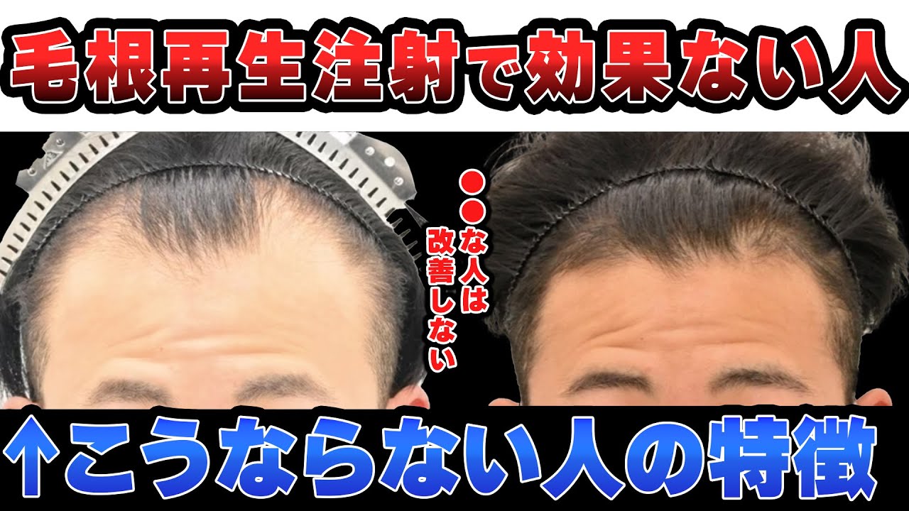 【AGA治療】毛根再生注射をしても効果ない事例。効果を得るためにおすすめの治療