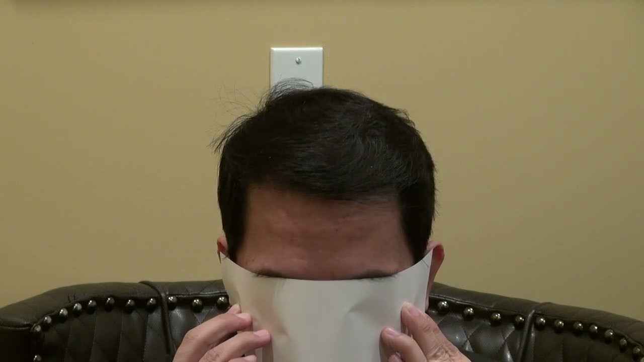 Male Lowering of the Hairline by Dr. John Diep | MHTA CLINIC