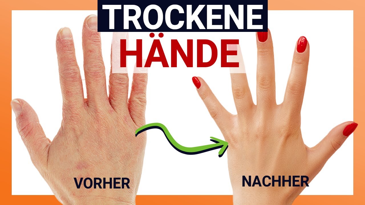 Trockene und rissige Hände ENDGÜLTIG loswerden 💅🏼