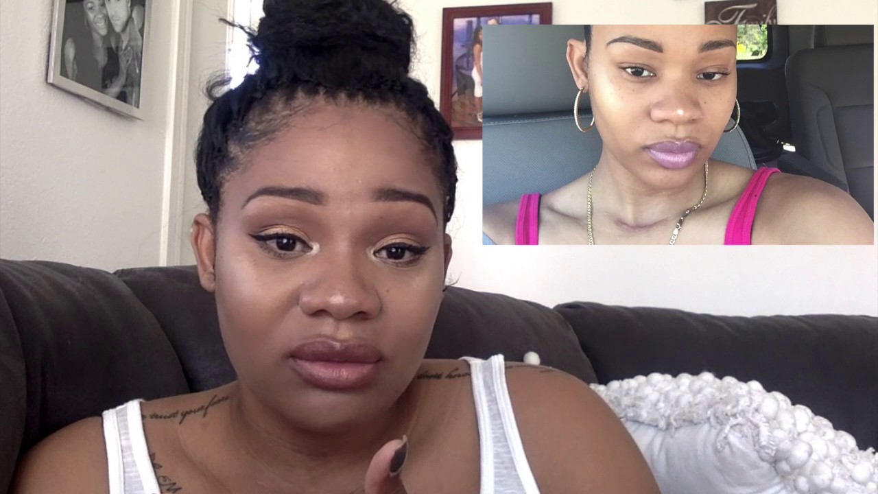 My Thyroid Cancer Story!!