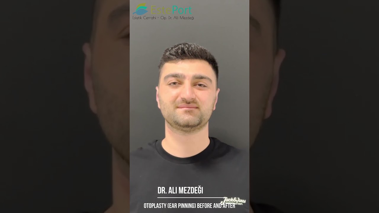 Otoplasty (Ear Pinning) Before and After: Dr. Ali Mezdegi