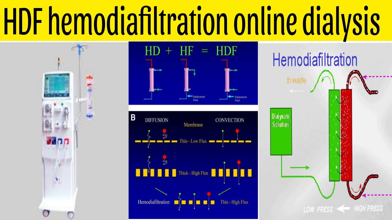 What is this Haemodiafiltration ||Diffusion, Convection|| Online HDF Hemodiafiltration