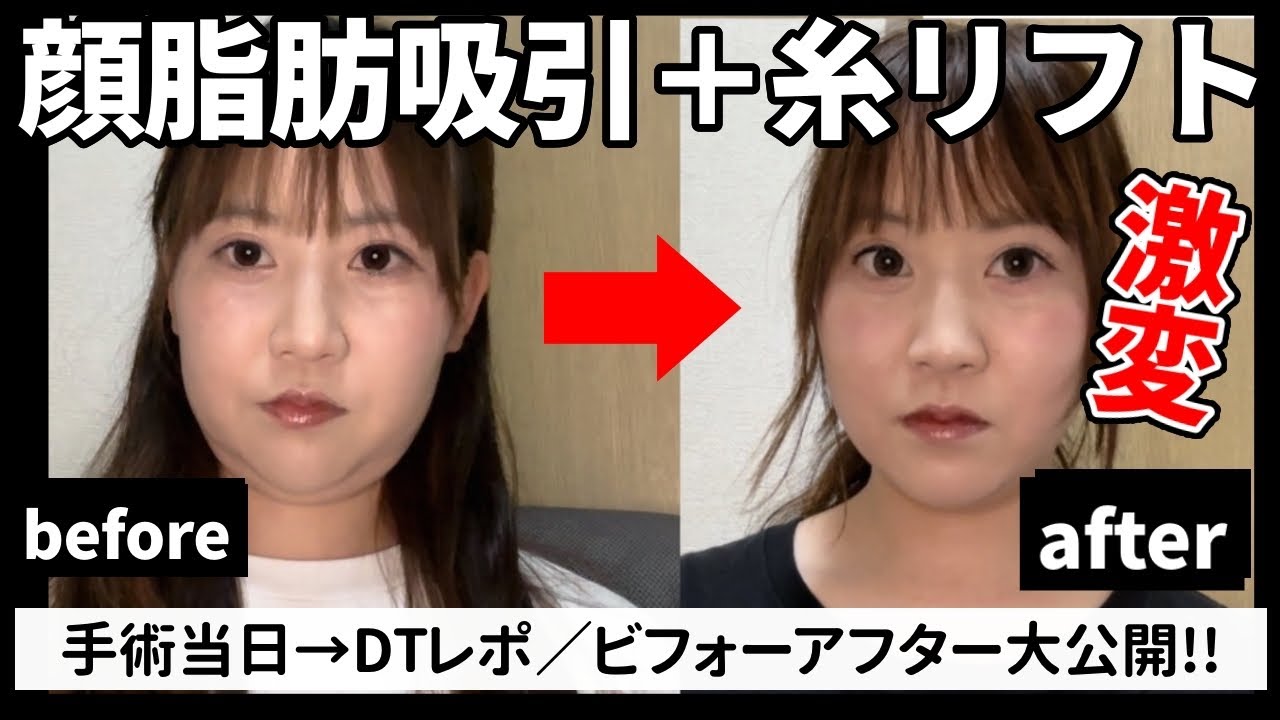 【脂肪吸引レポ】頬•顎下脂肪吸引＆糸リフトのダウンタイムの様子。二重顎サヨウナラ【湘南美容クリニック】ジョールファット除去