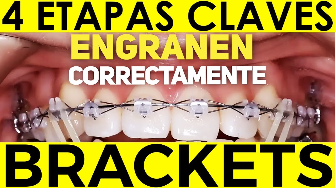 ¿Cuáles son las ETAPAS del TRATAMIENTO para enderezar DIENTES CHUECOS con el uso de los BRACKETS?