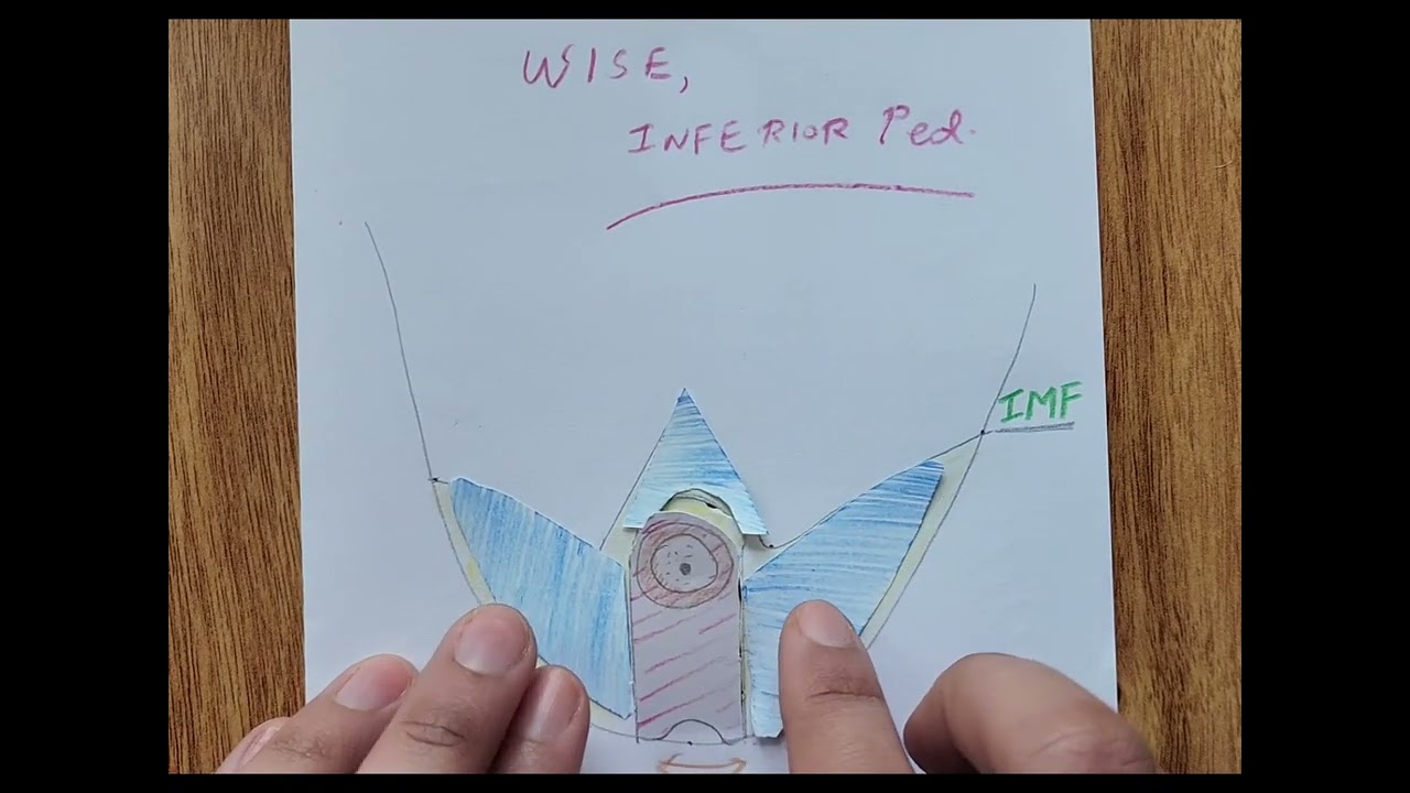 Steps of surgery - Wise pattern, inferior pedicle.