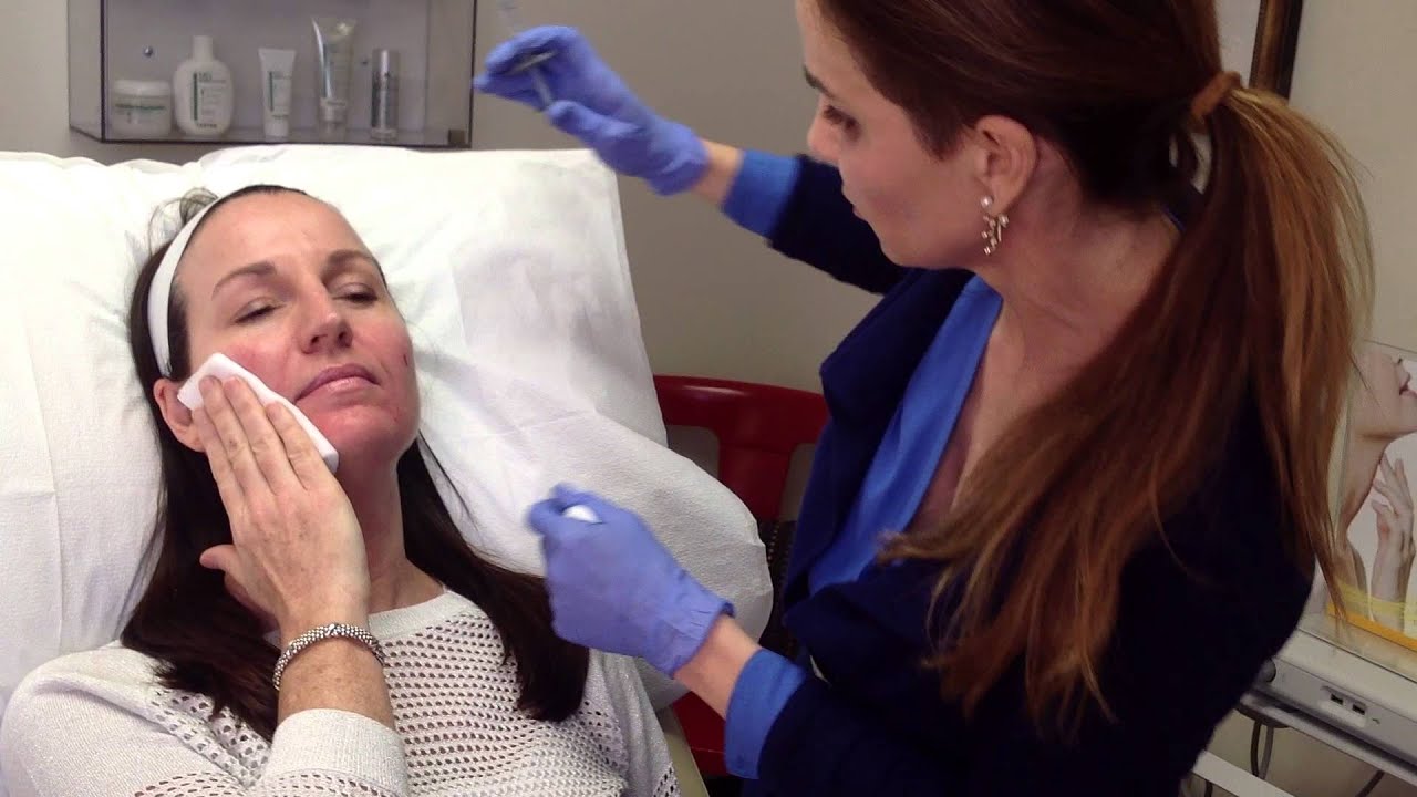 Juvederm Voluma filler demonstration
