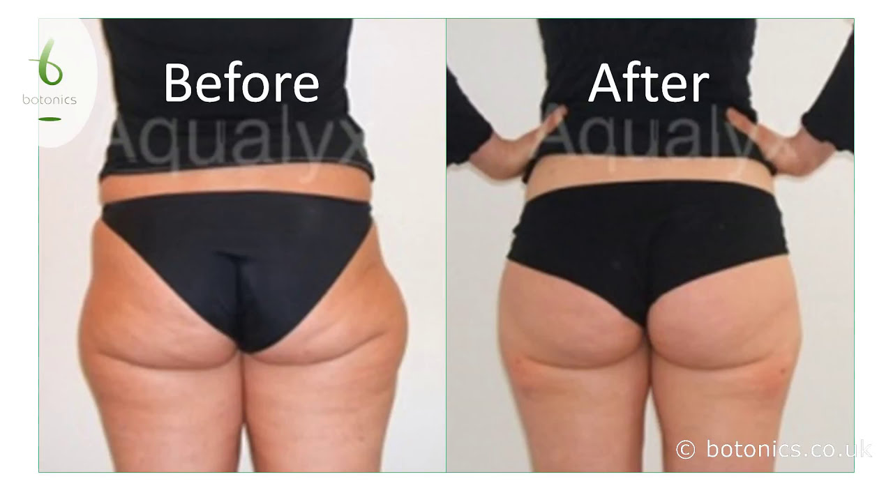 Aqualyx Fat Dissolving Injections at botonics
