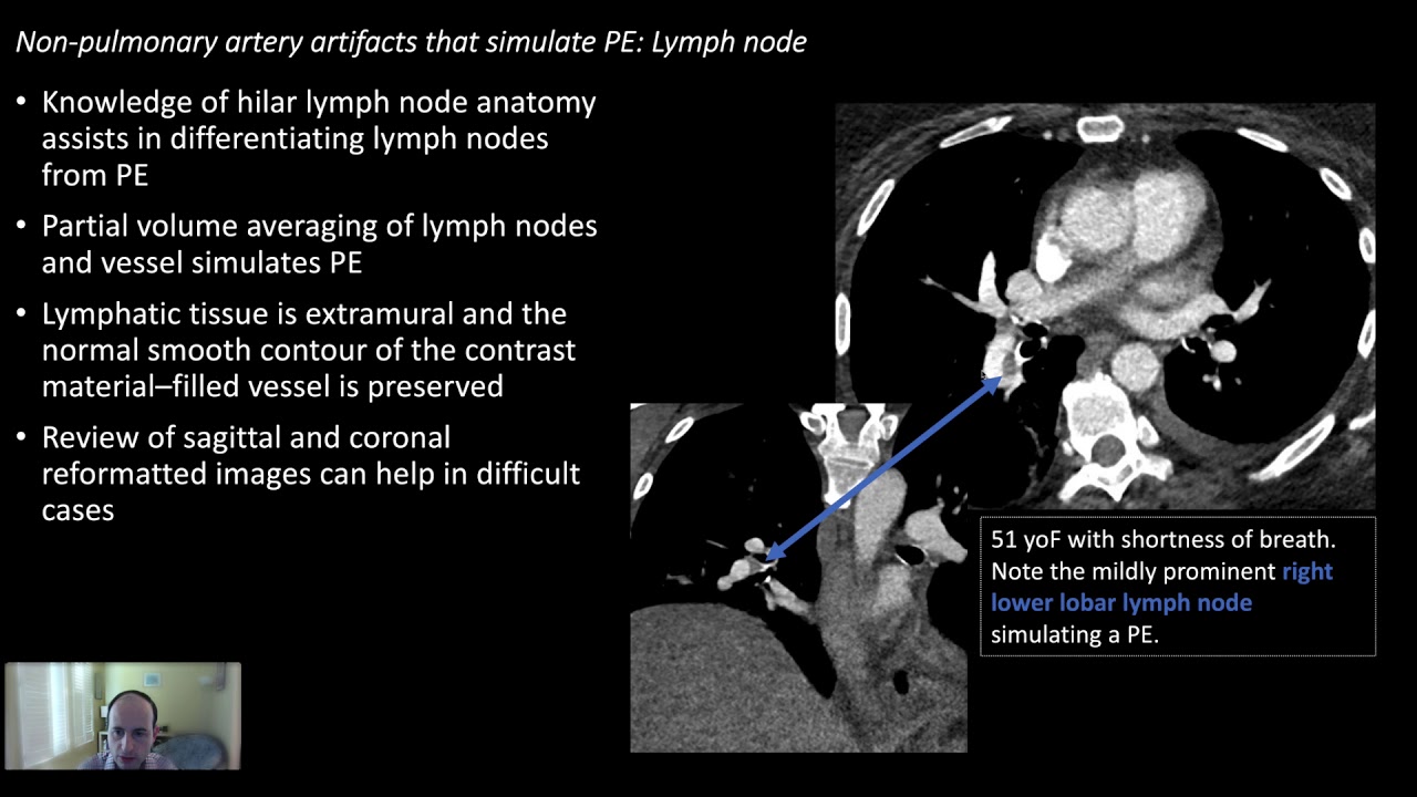 Pitfalls in Interpreting CT Pulmonary Angiograms