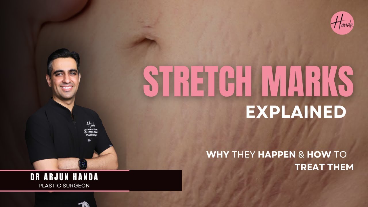 Stretch Marks हटाने में Laser Treatment कितना Effective है? | Dr. Arjun Handa | Handa Aesthetics
