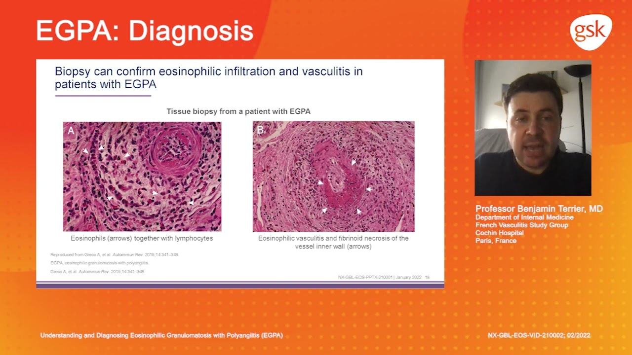 Diagnosis: Understanding and diagnosing eosinophilic granulomatosis with polyangiitis (EGPA)
